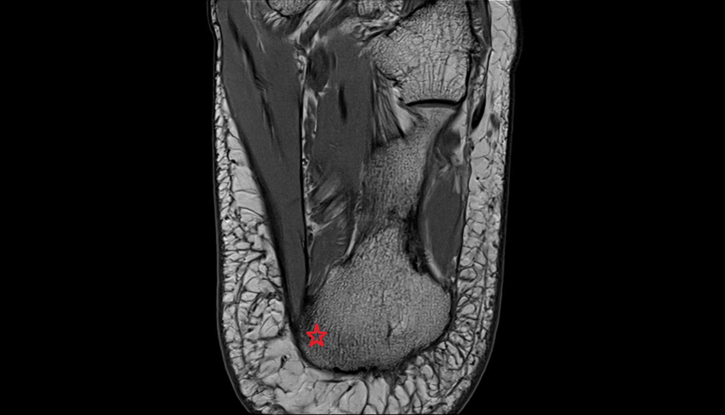 Medial process of calcaneal tuberosity  mri  anatomy labelled image-img-00000-00000