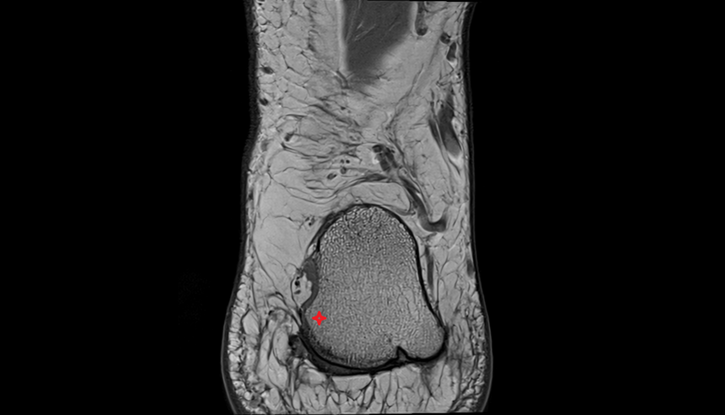 Medial process of calcaneal tuberosity  mri  anatomy labelled image-img-00000-00000_00001