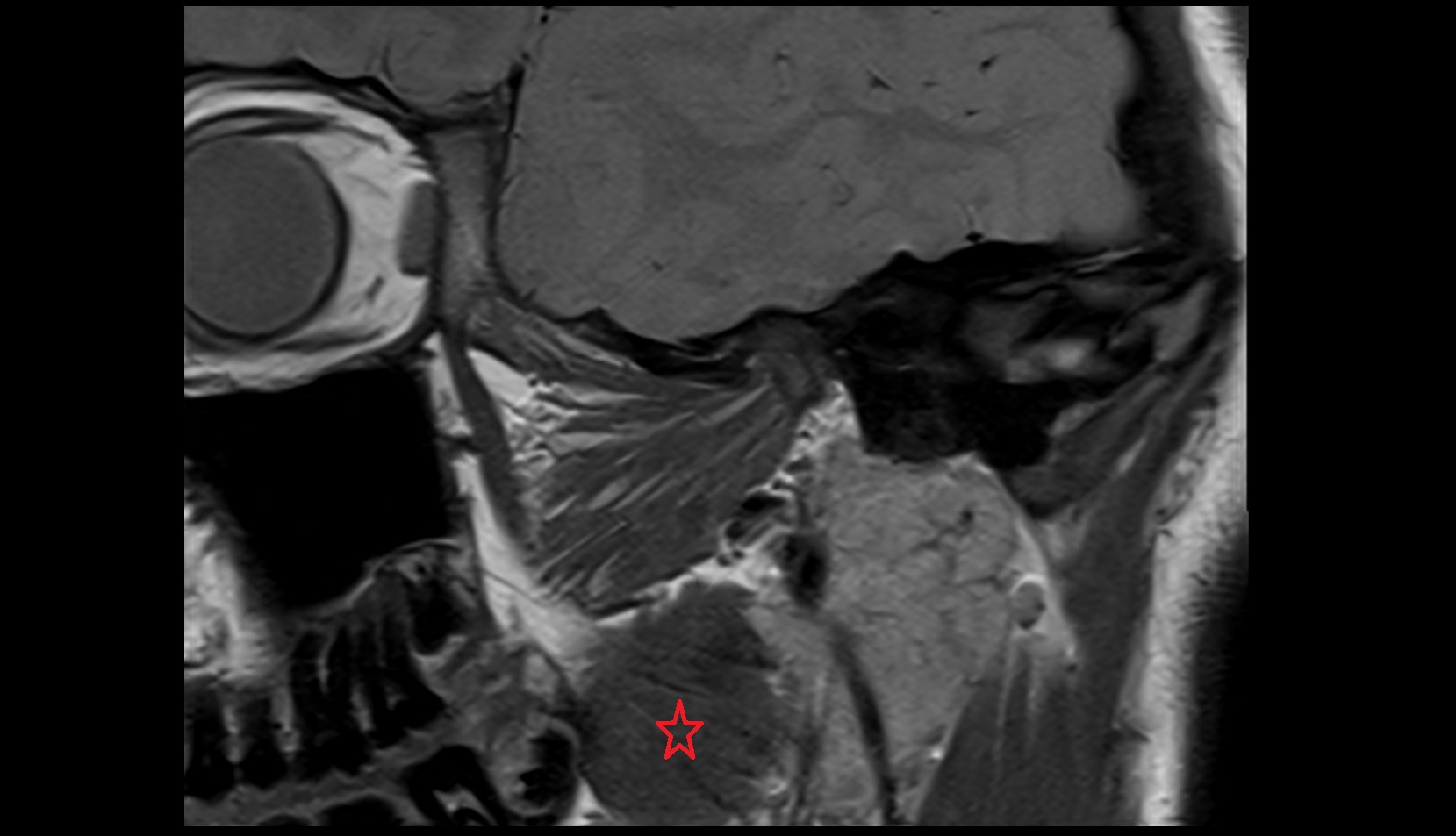 Medial pterygoid muscle mri