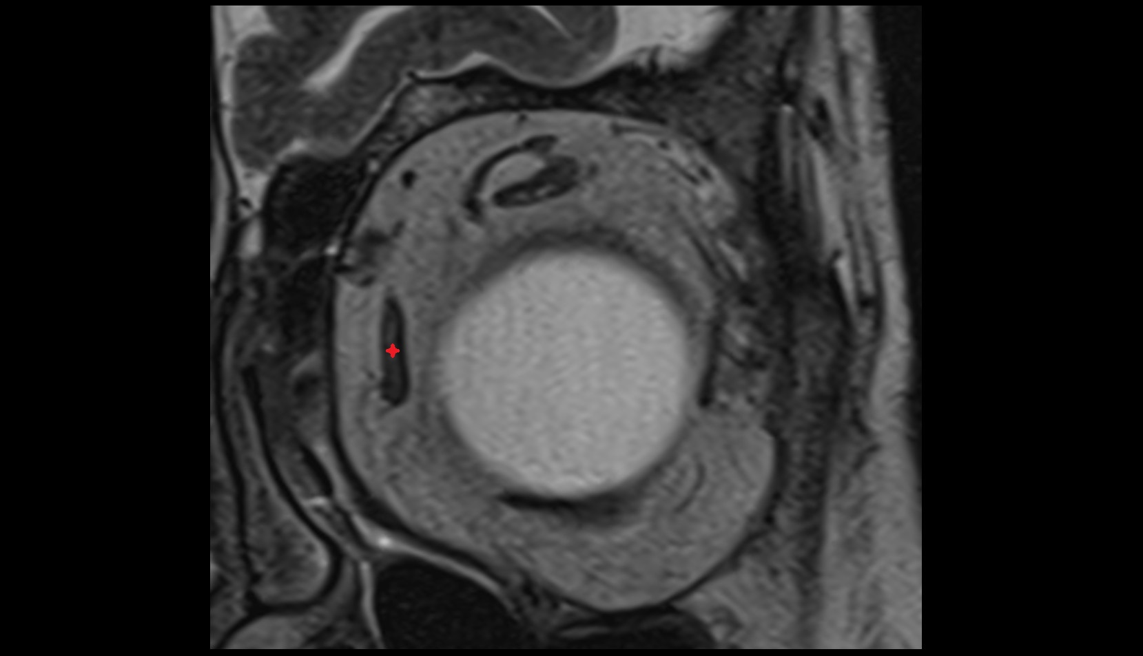 Medial rectus muscle mri image