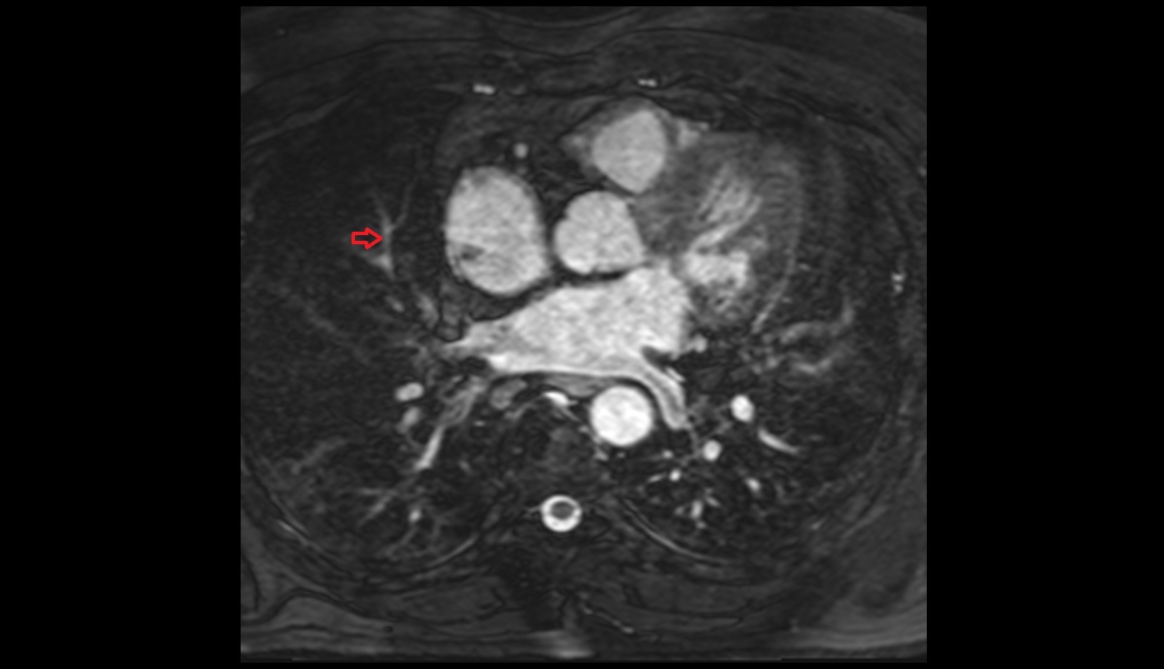 Medial segmental artery of right lung  MRI IMAGE