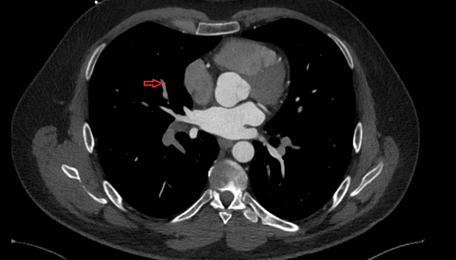 Medial segmental artery of right lung   anatomy CT axial  image -img-00000-00000