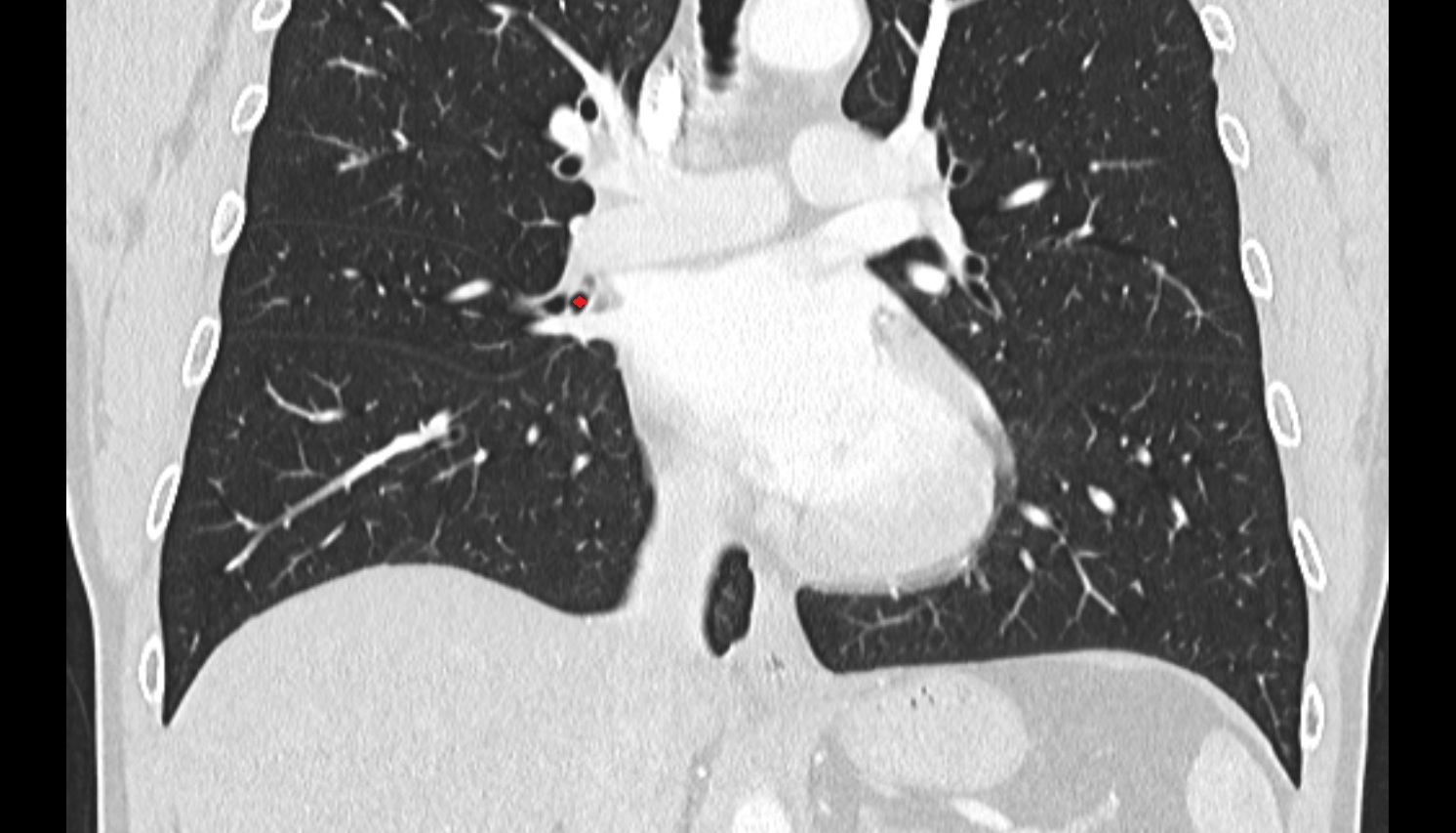 Medial segmental bronchus of right lung (B5)  anatomy  CT coronal  image -img-00000-00000