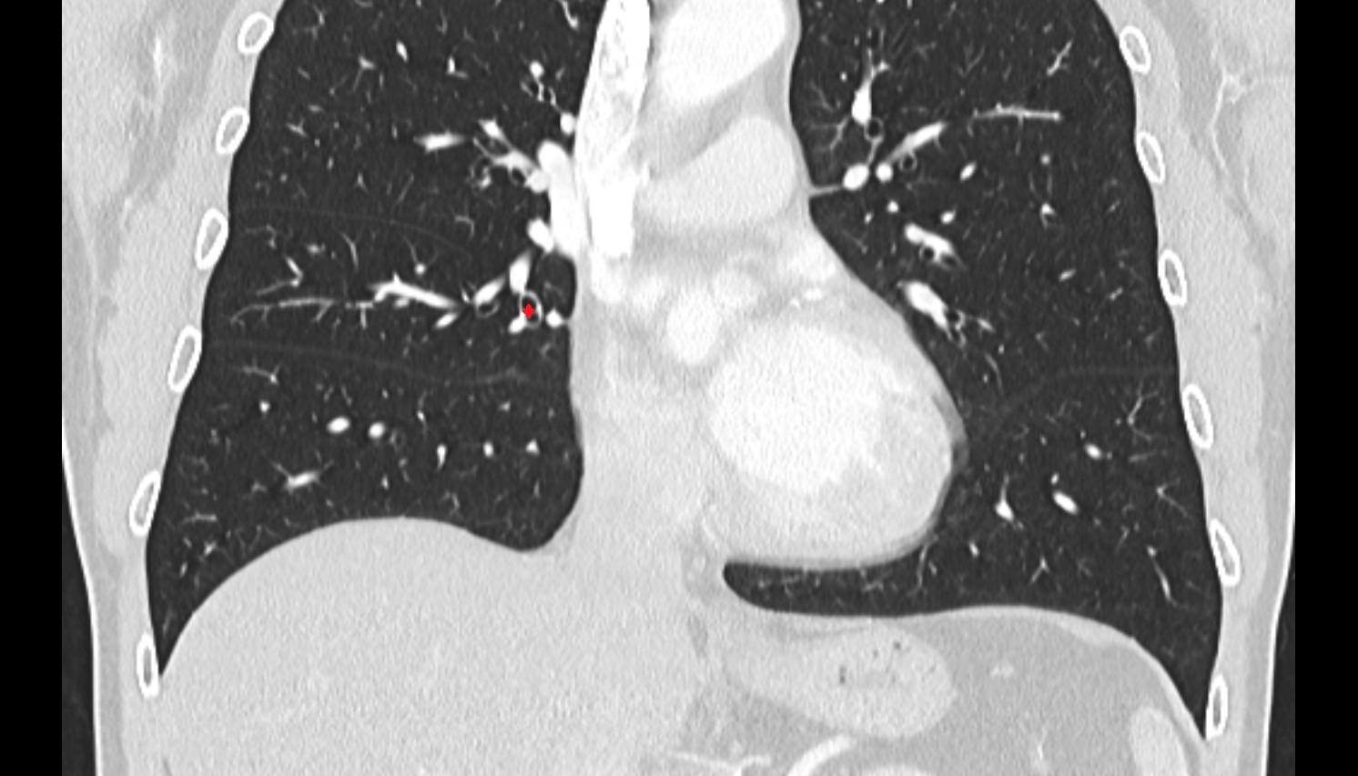 Medial segmental bronchus of right lung (B5)  anatomy  CT coronal  image -img-00000-00000_00001