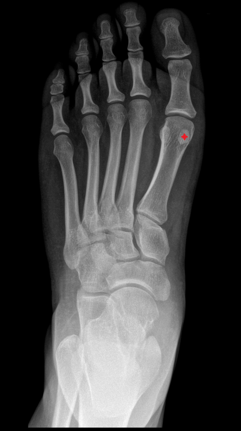 Medial sesamoid bone