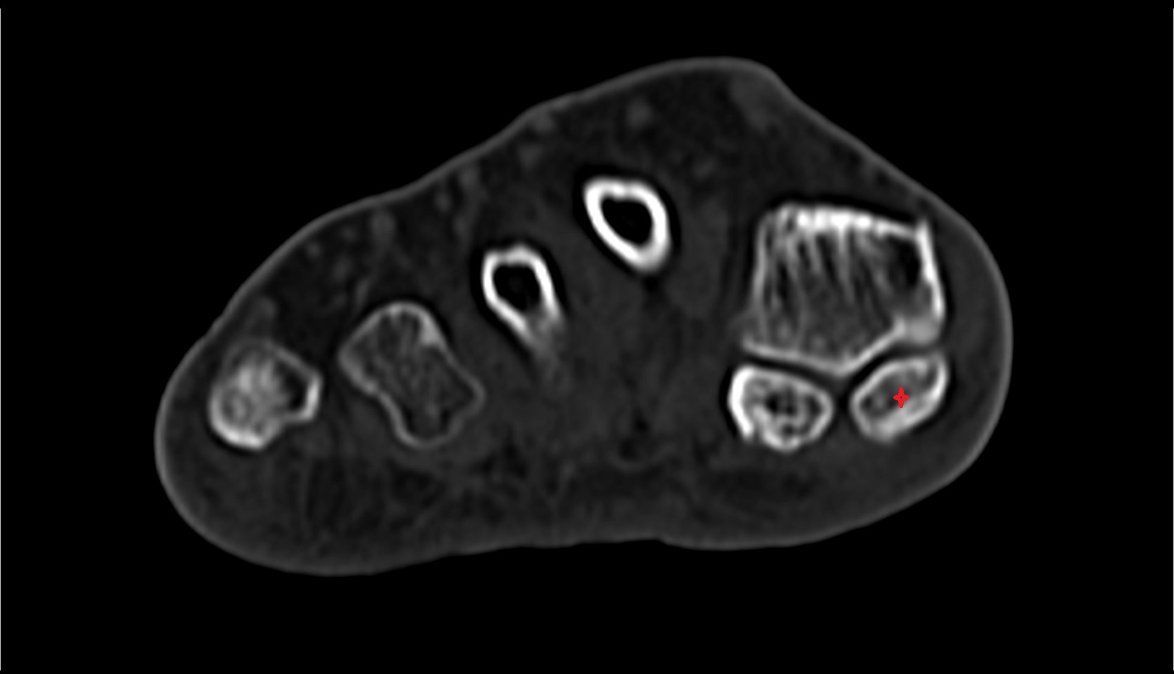Medial sesamoid bone CT axial image