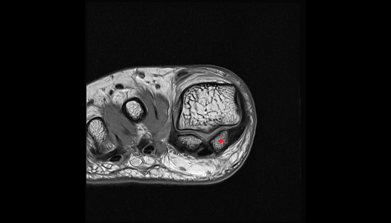 Medial sesamoid bone axial cross sectional anatomy 3T MRI AI enhanced radiology image-img-00000-00000