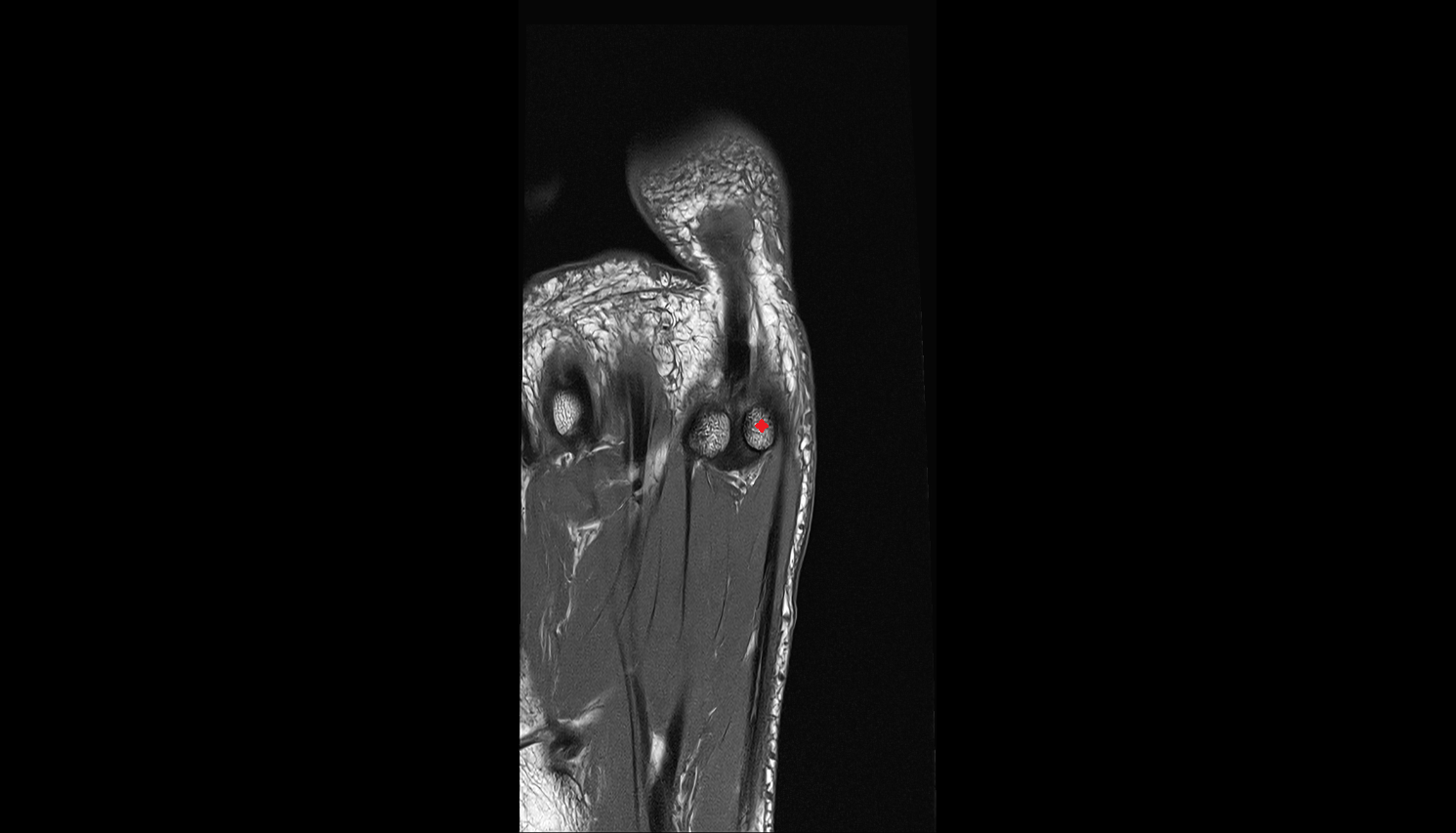 Medial sesamoid bone coronal cross sectional anatomy 3T MRI AI enhanced radiology image-img-00000-00000