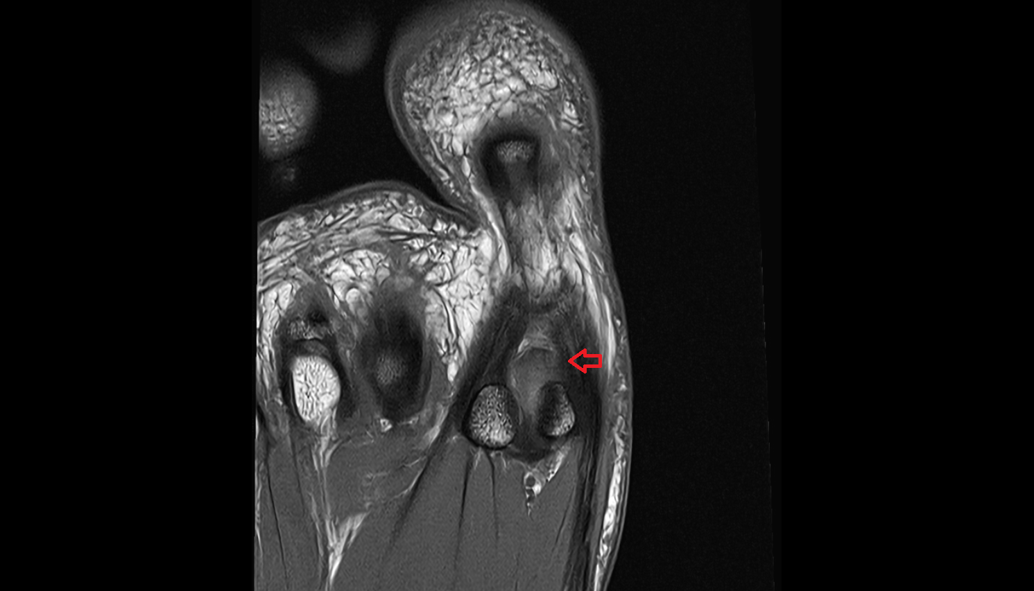 Medial sesamoid phalangeal ligament of foot  coronal cross sectional anatomy 3T MRI AI enhanced radiology image-img-00000-00000
