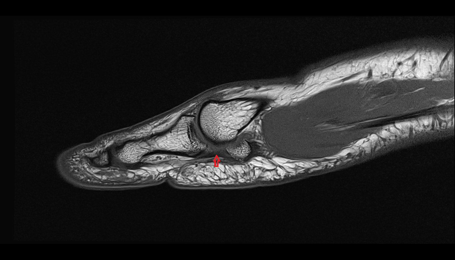 Medial sesamoid phalangeal ligament of foot  sag cross sectional anatomy 3T MRI AI enhanced radiology image-img-00000-00000