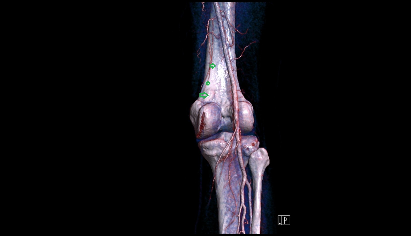 Medial supracondylar line 3d