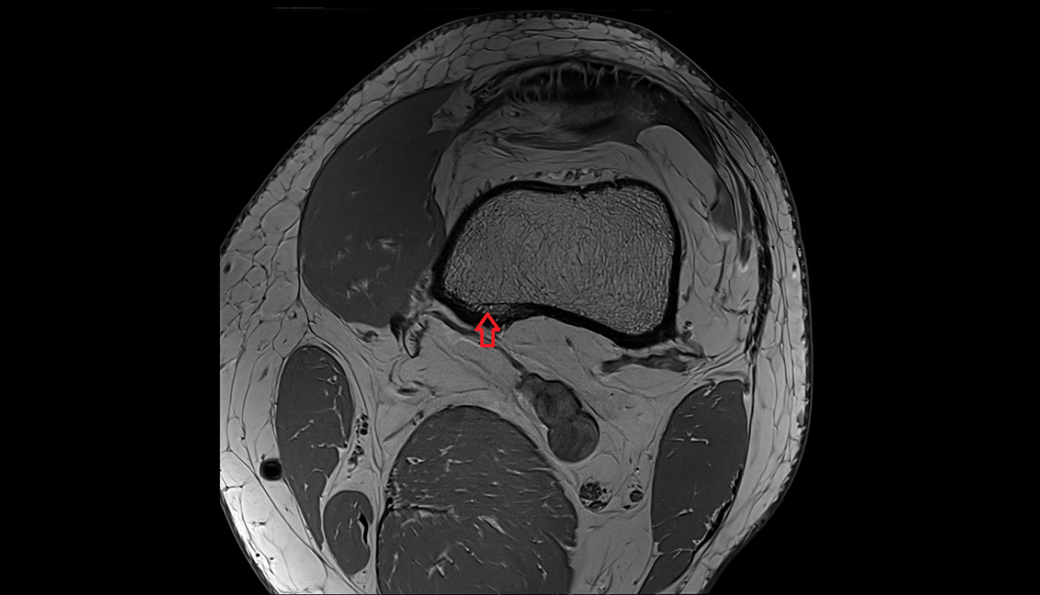 Medial supracondylar line  mri  anatomy labelled image-img-00000-00000