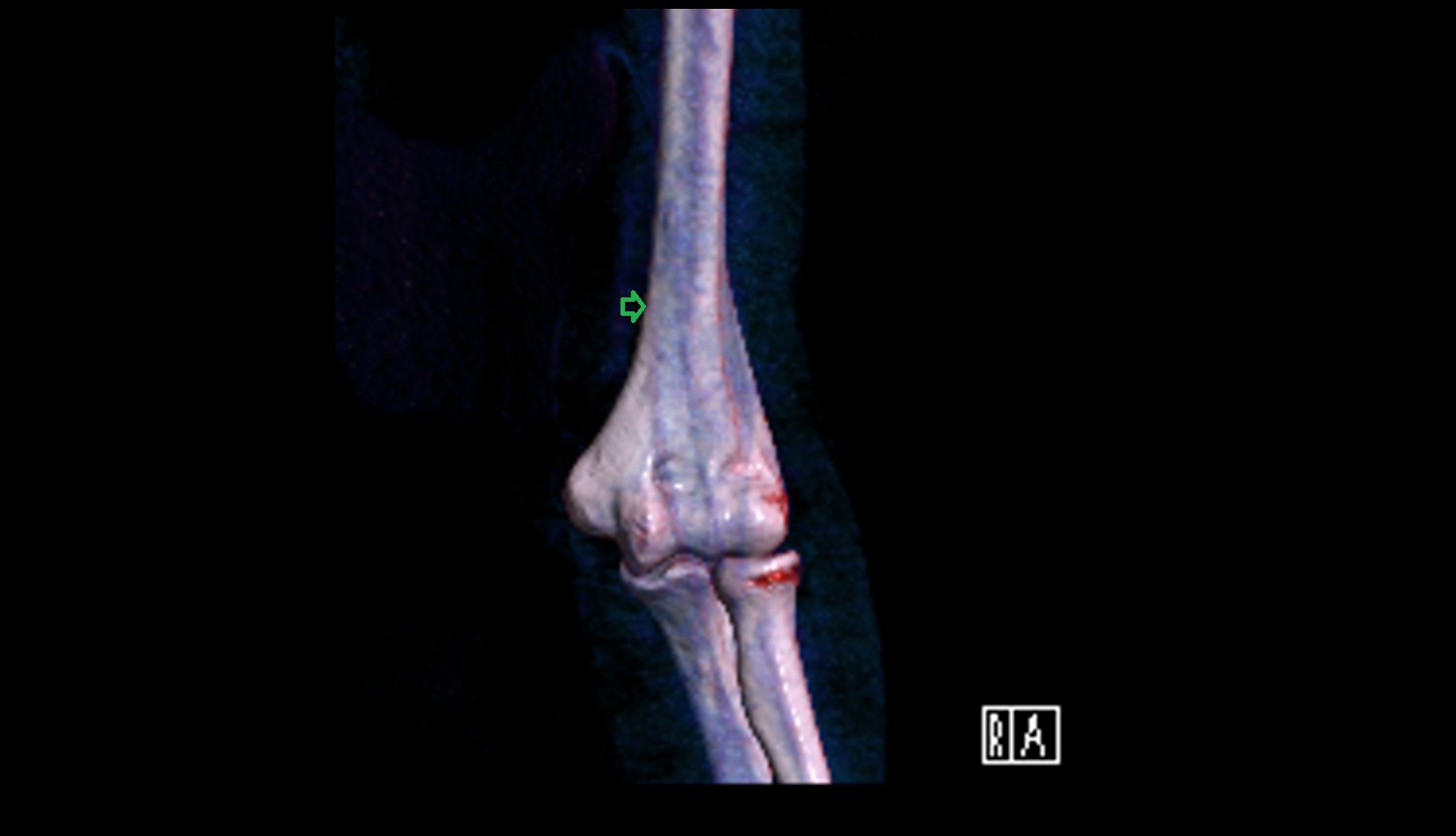 Medial supracondylar ridge 3D VRT IMAGE