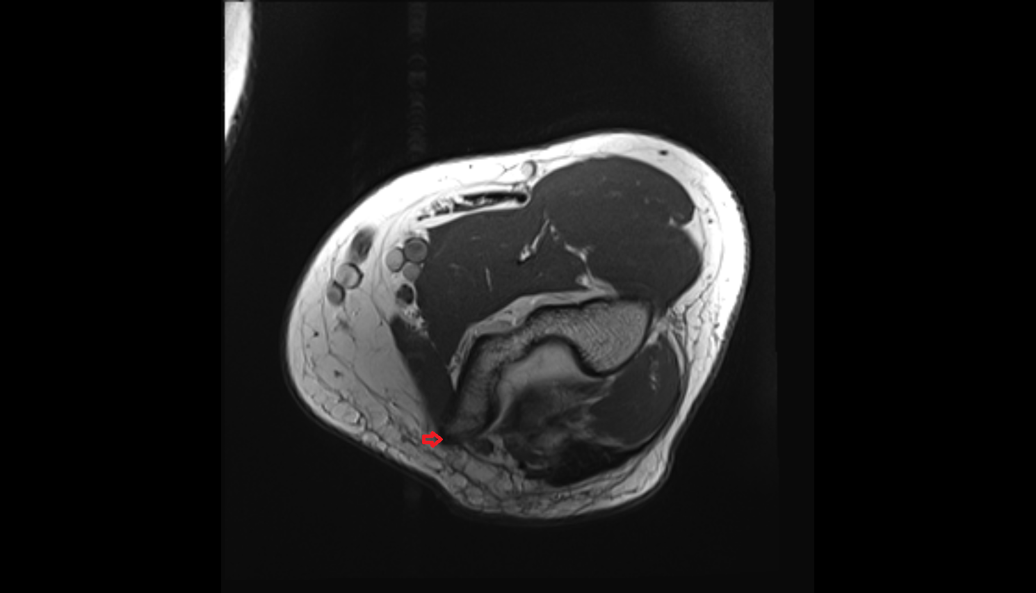 Medial supracondylar ridge coronal cross sectional anatomy 3T MRI AI enhanced radiology image -img-00000-00000_00001