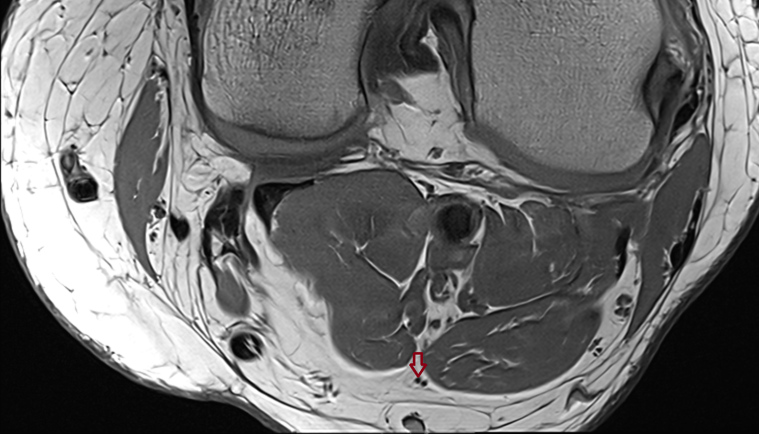 Medial sural cutaneous nerve  axial  cross sectional anatomy 3T MRI AI enhanced  radiology  anatomy image-img-00000-00000_00001