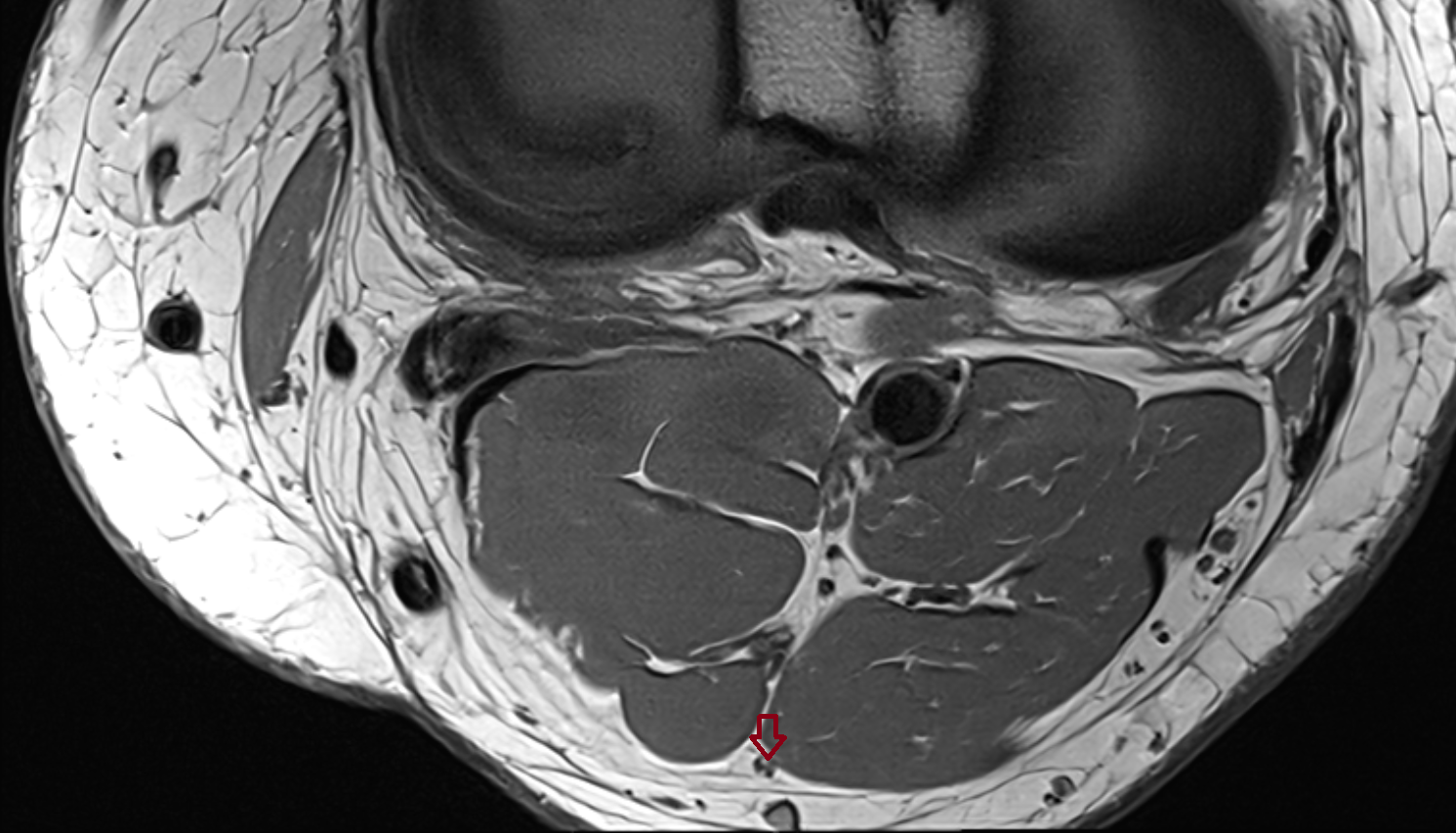 Medial sural cutaneous nerve  axial  cross sectional anatomy 3T MRI AI enhanced  radiology  anatomy image-img-00000-00000_00002