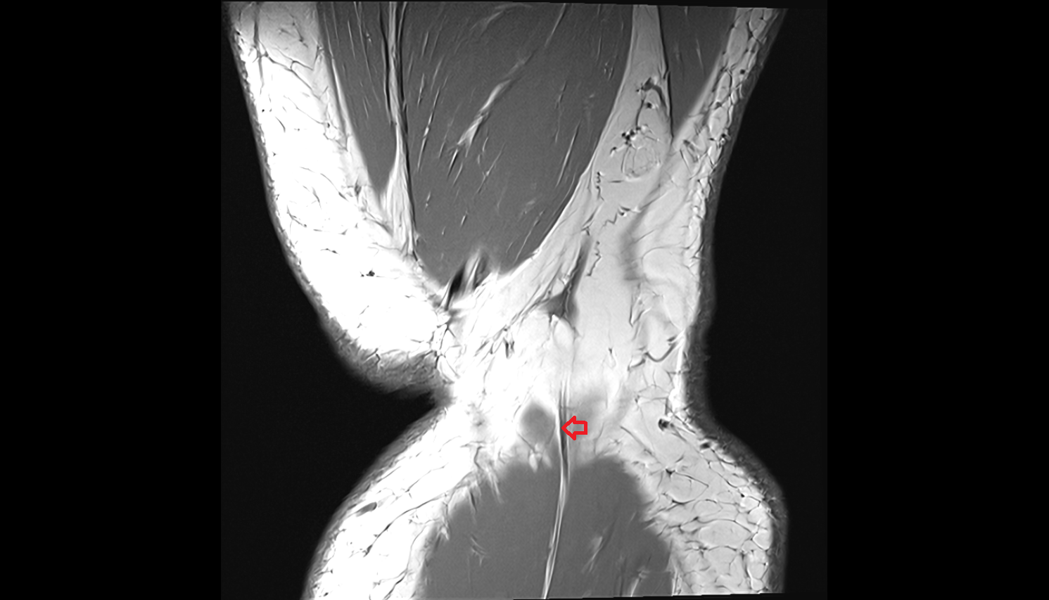 Medial sural cutaneous nerve  coronal  cross sectional anatomy 3T MRI AI enhanced  radiology  anatomy image-img-00000-00000
