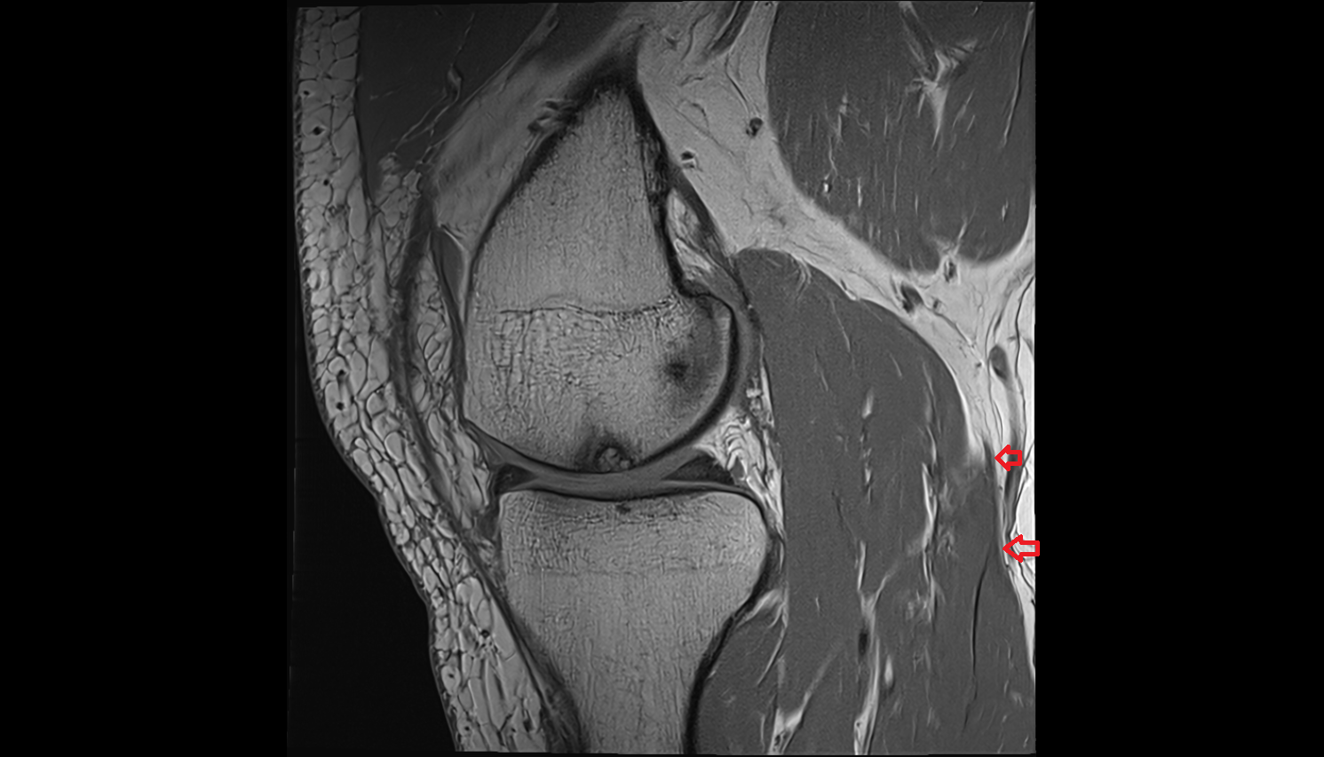 Medial sural cutaneous nerve  coronal  cross sectional anatomy 3T MRI AI enhanced  radiology  anatomy image-img-00000-00000_00001