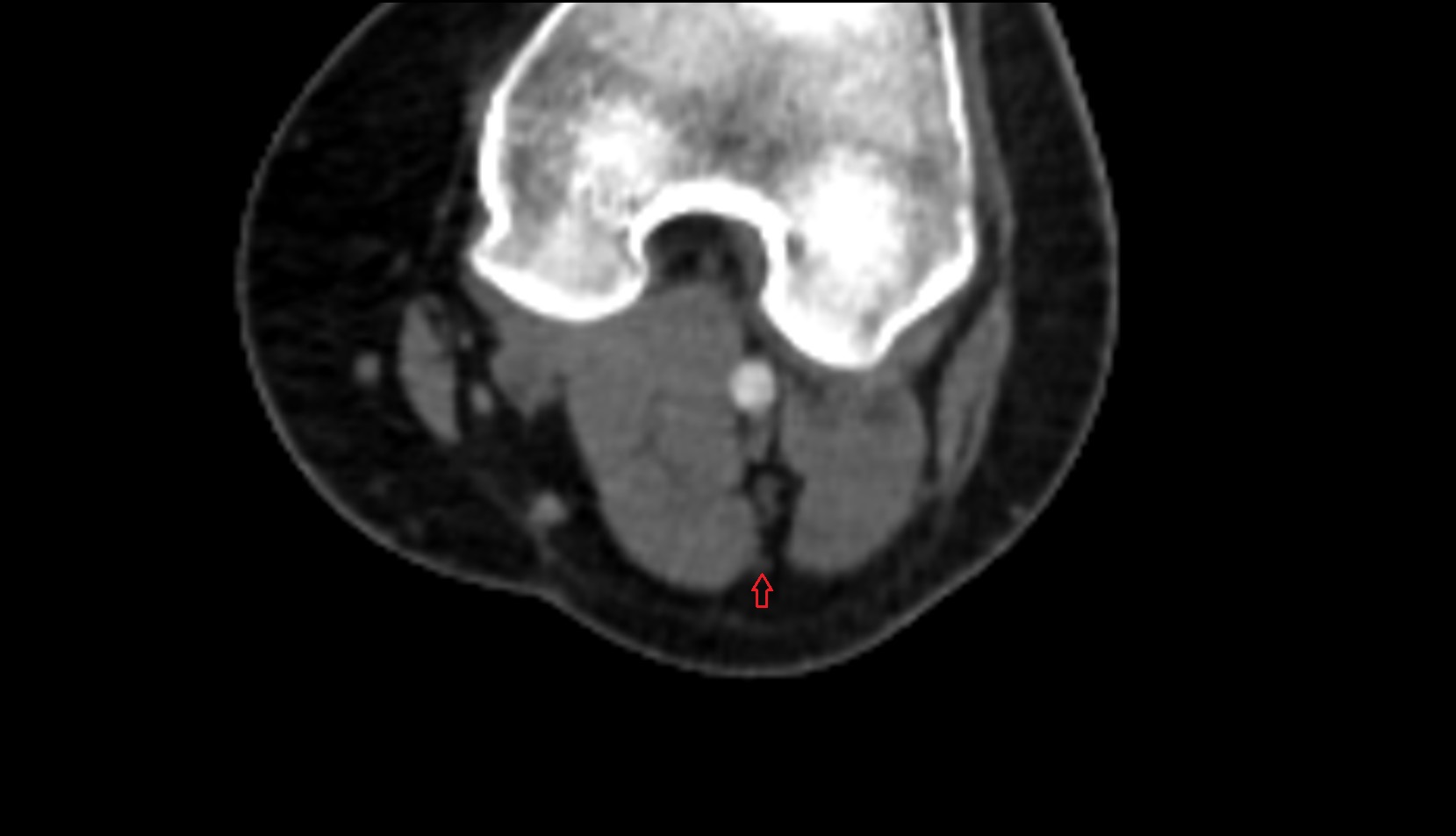 Medial sural cutaneous nerve ct axial