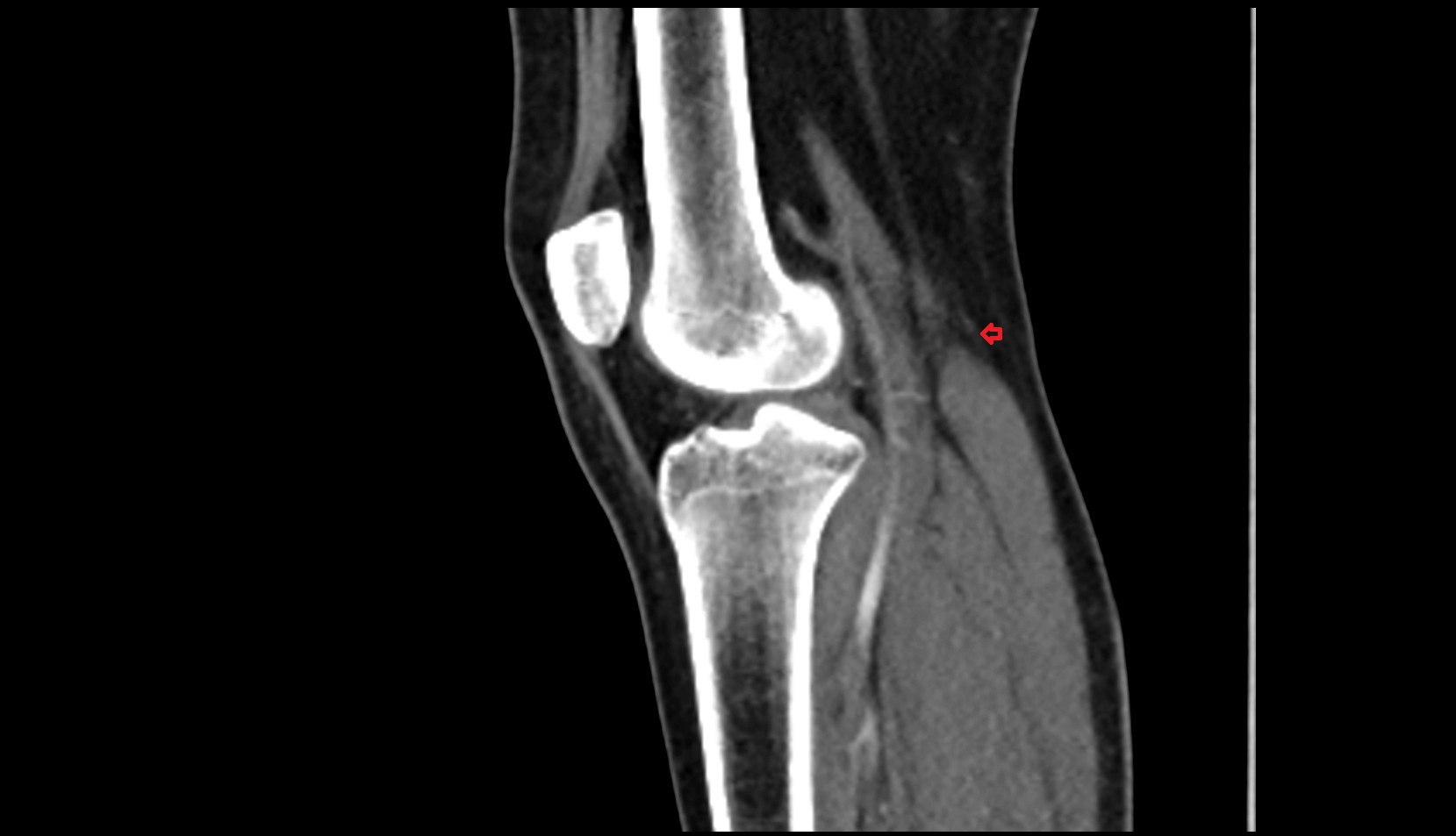 Medial sural cutaneous nerve sag ct image