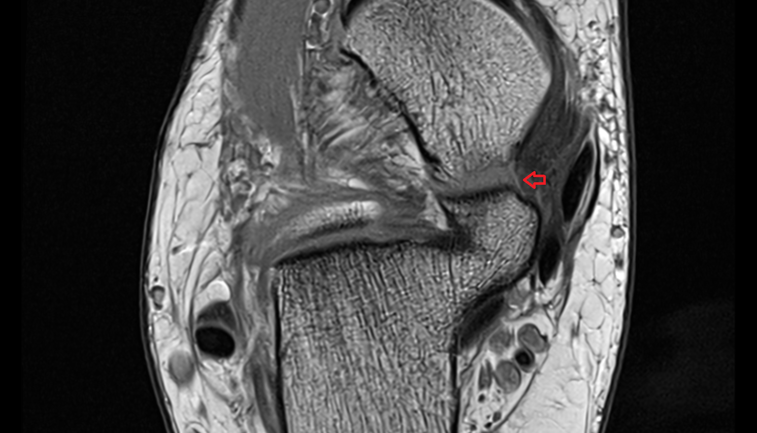 Medial talocalcaneal ligament  axial cross sectional anatomy 3T MRI AI enhanced radiology image-img-00000-00000