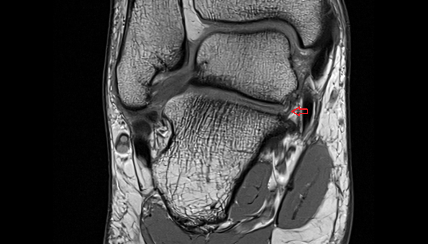 Medial talocalcaneal ligament  coronal cross sectional anatomy 3T MRI AI enhanced radiology image-img-00000-00000