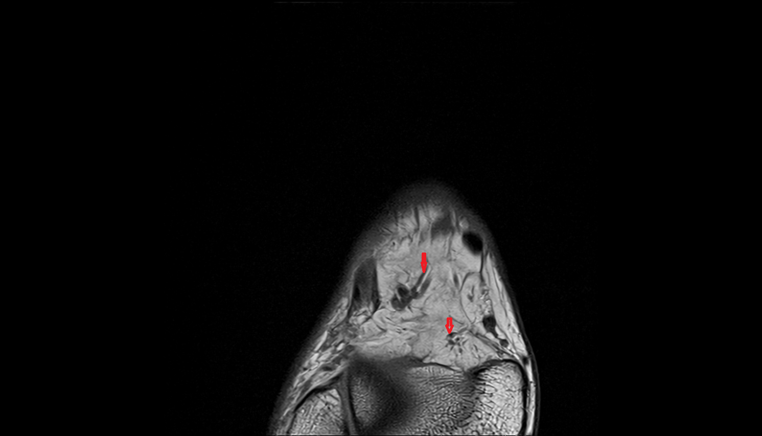Medial tarsal arteries  axial  cross sectional anatomy 3T MRI AI enhanced radiology image-img-00000-00000