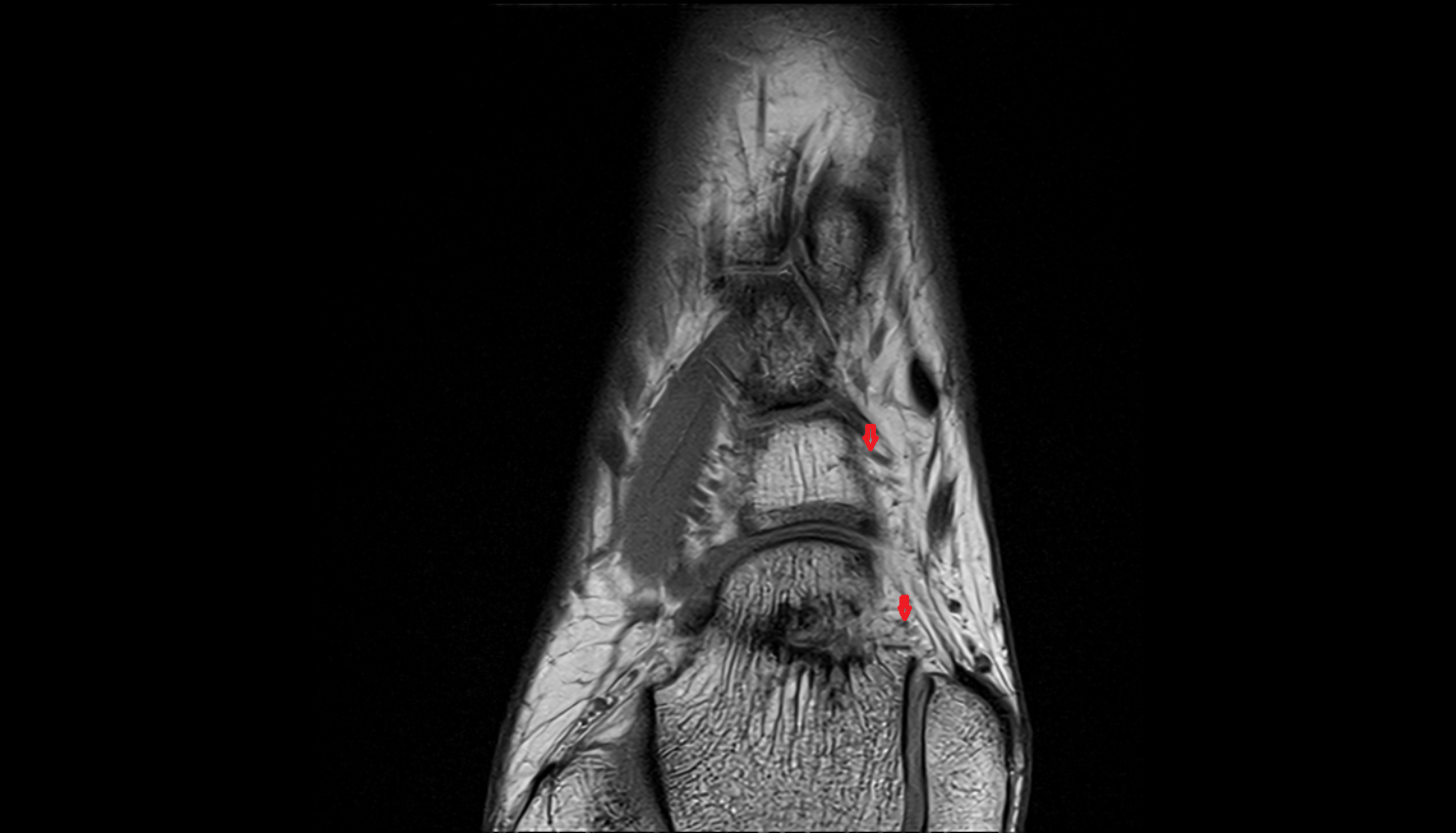 Medial tarsal arteries  axial  cross sectional anatomy 3T MRI AI enhanced radiology image-img-00000-00000_00002