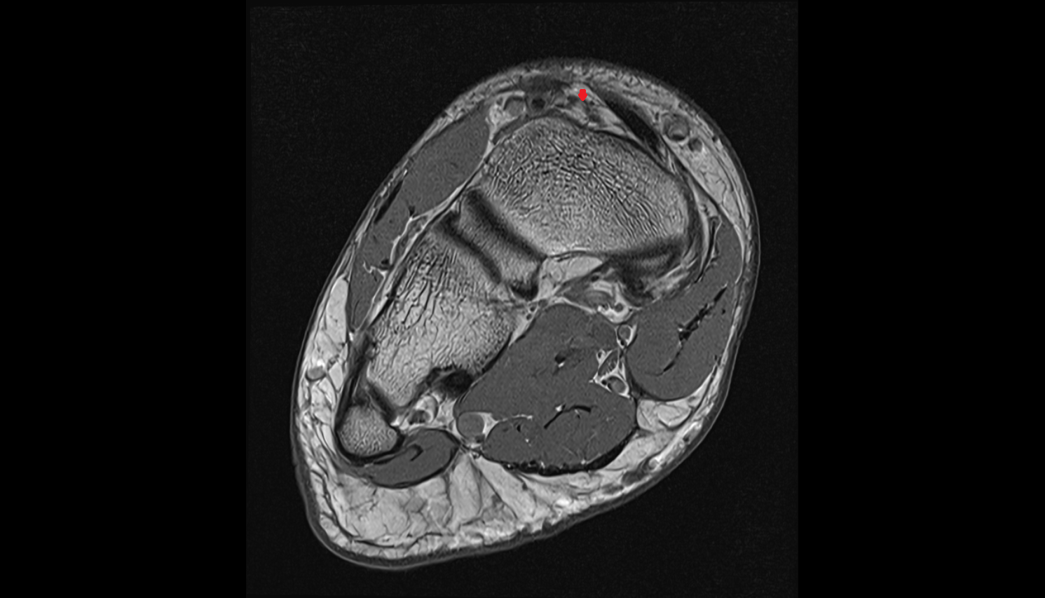 Medial tarsal veins  of foot coronal cross sectional anatomy 3T MRI AI enhanced radiology image-img-00000-00000