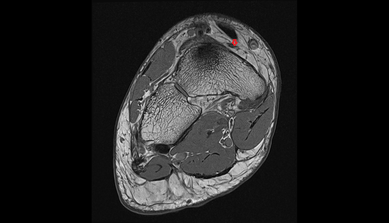 Medial tarsal veins  of foot coronal cross sectional anatomy 3T MRI AI enhanced radiology image-img-00000-00000_00001