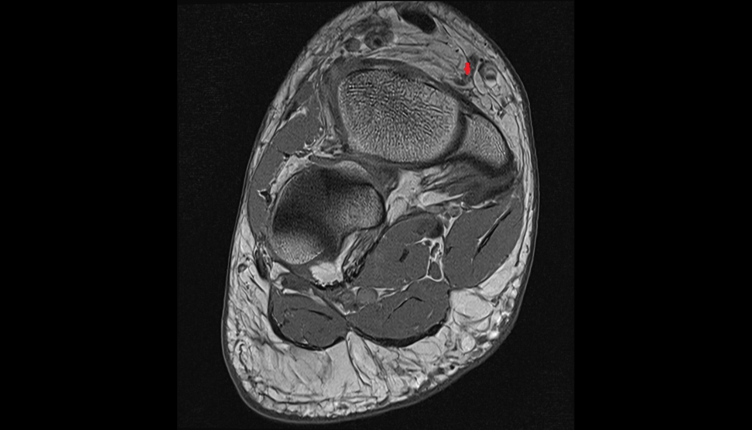 Medial tarsal veins  of foot coronal cross sectional anatomy 3T MRI AI enhanced radiology image-img-00000-00000_00002