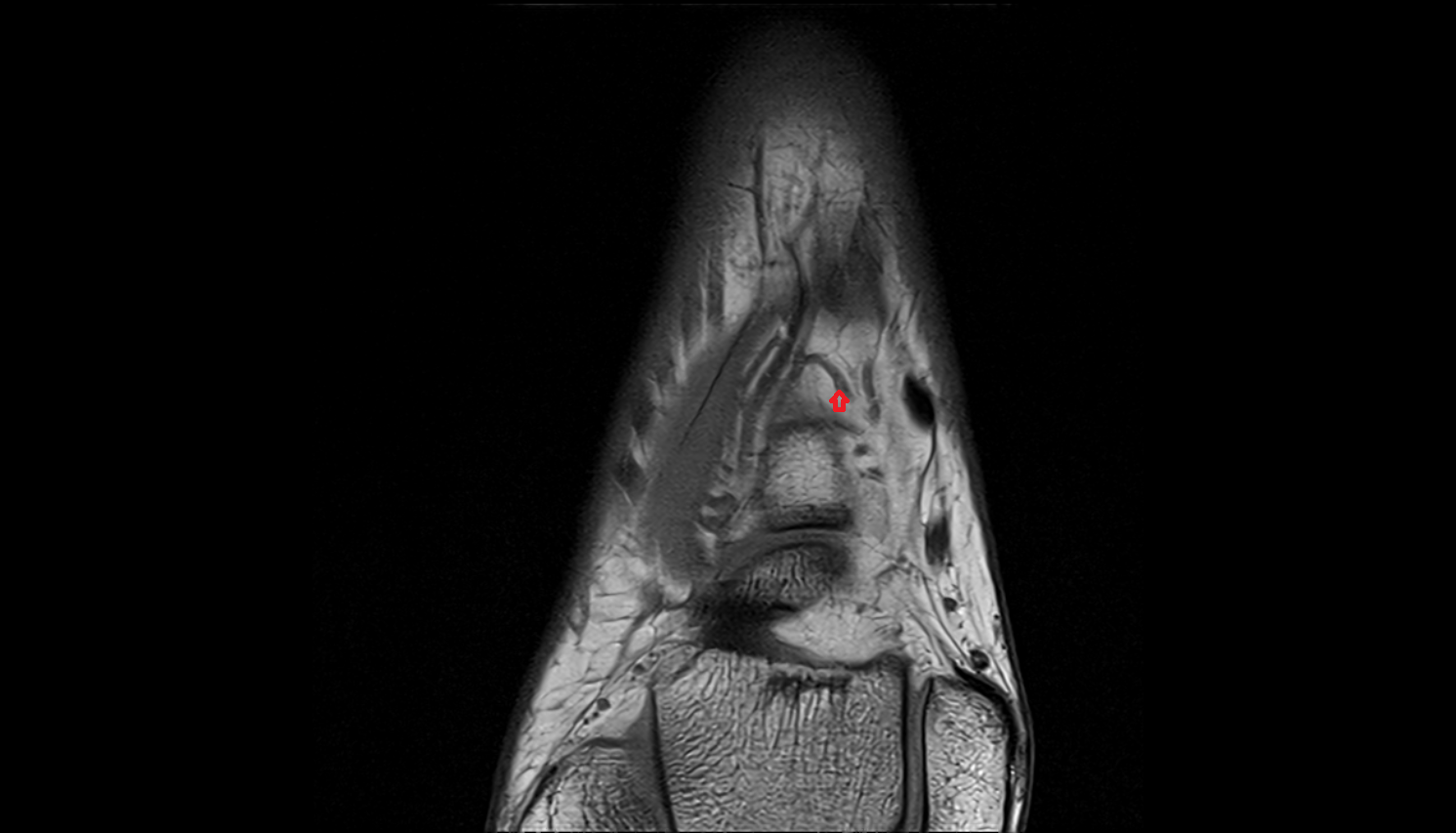 Medial tarsal veins  of foot coronal cross sectional anatomy 3T MRI AI enhanced radiology image-img-00000-00000_00003