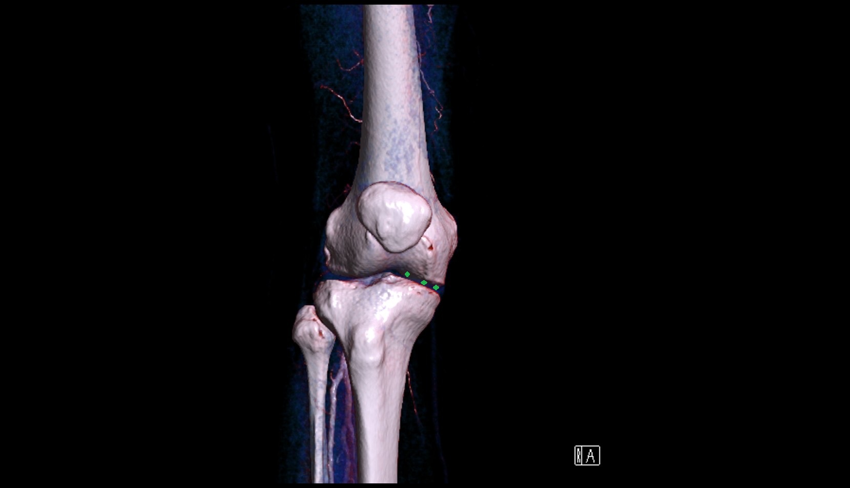 Medial tibiofemoral joint space