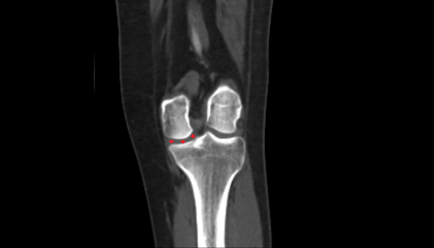 Medial tibiofemoral joint space