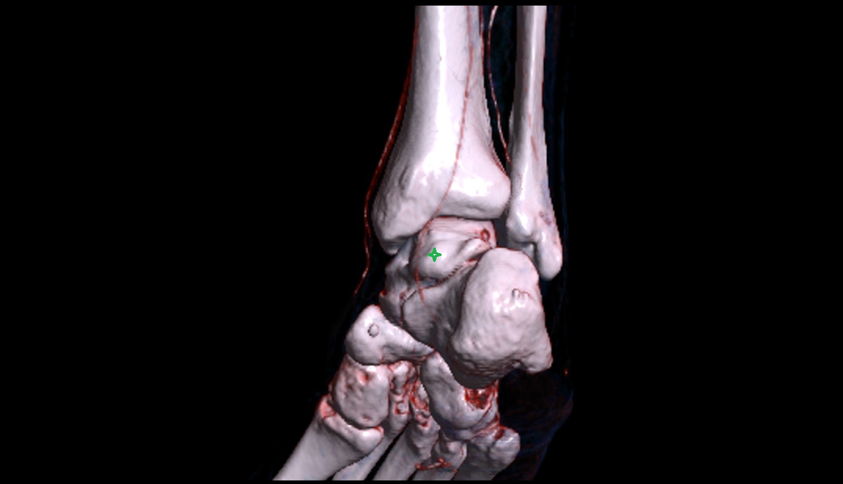 Medial tubercle of talus 3d
