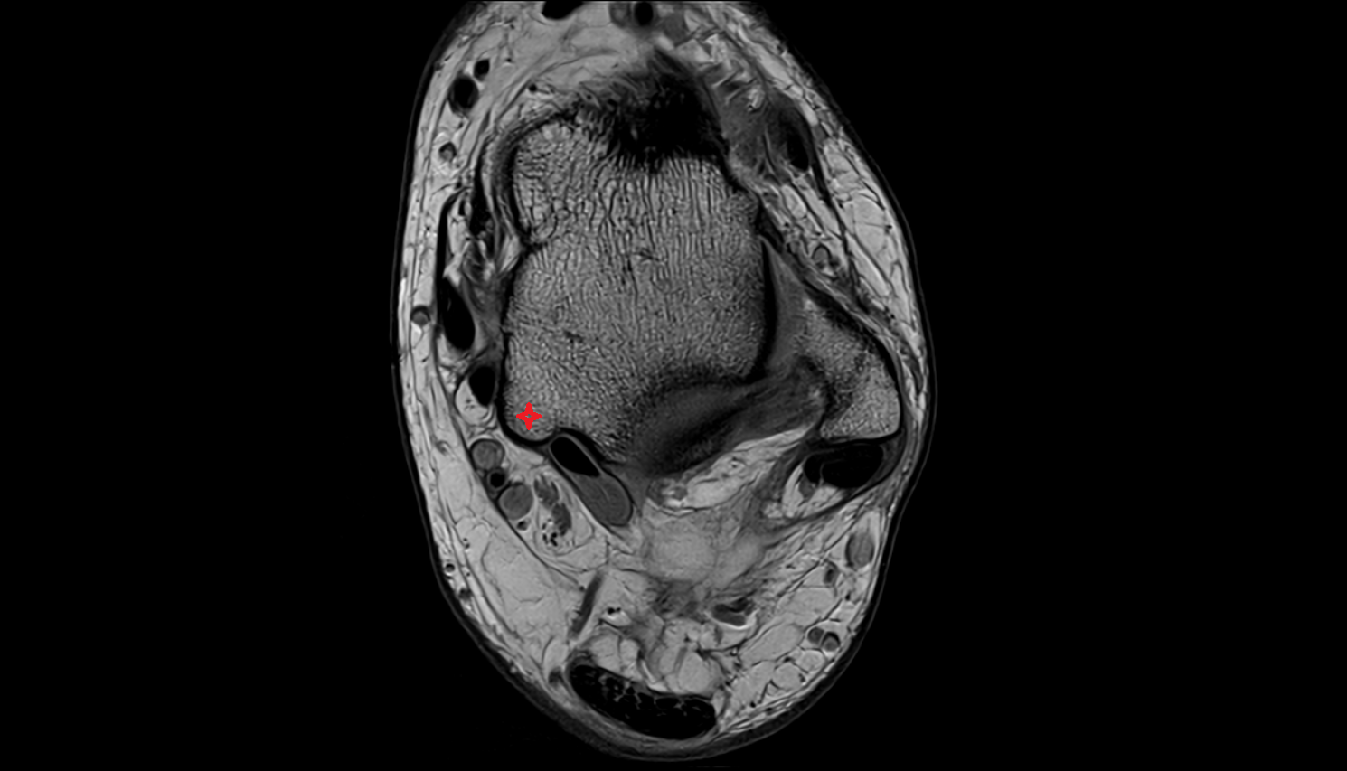 Medial tubercle of talus  mri  anatomy labelled image-img-00000-00000