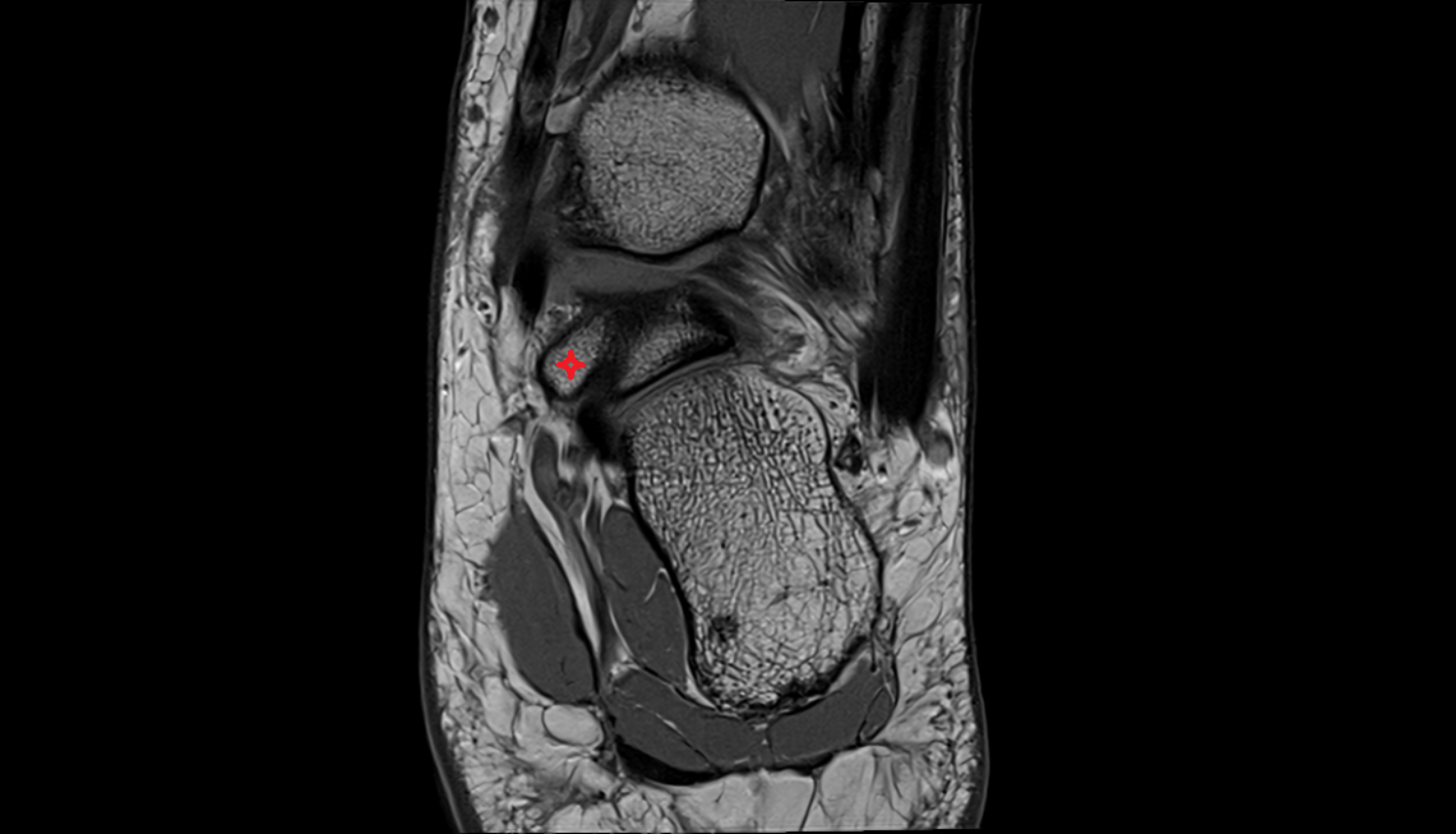 Medial tubercle of talus  mri  anatomy labelled image-img-00000-00000_00001
