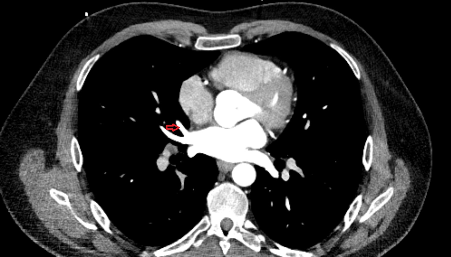 Medial vein of right lung anatomy CT axial  image -img-00000-00000