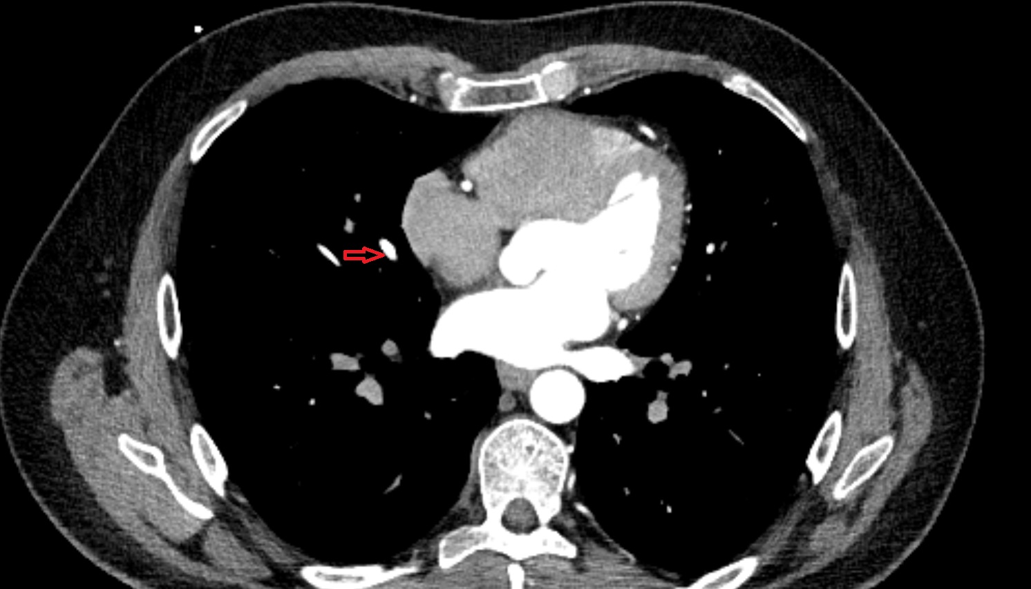 Medial vein of right lung anatomy CT axial  image -img-00000-00000_00001