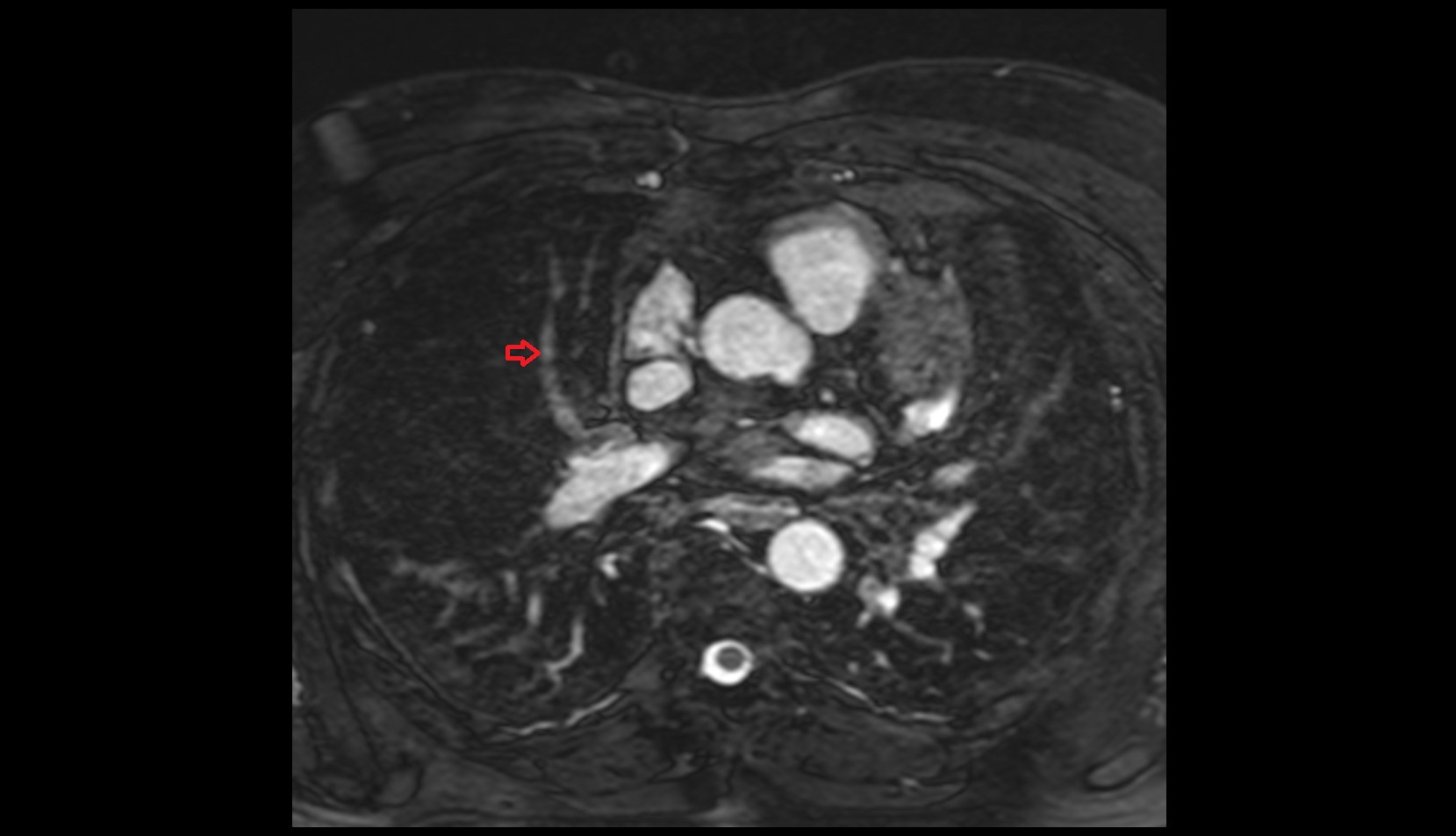 Medial vein of right lung mri axial image