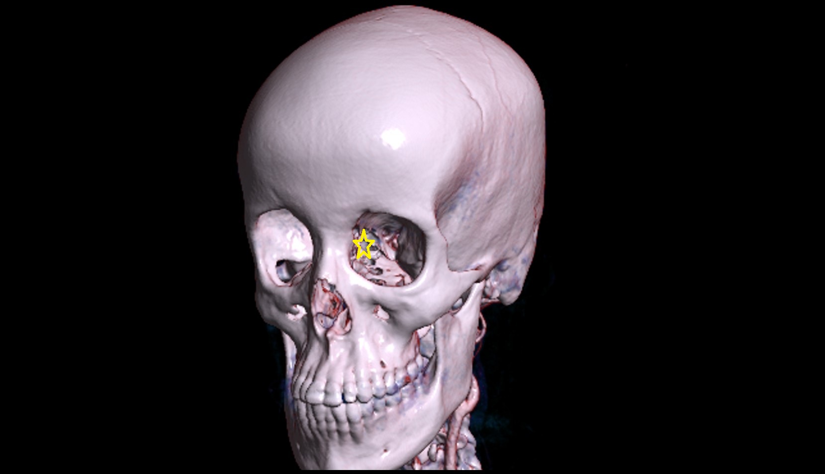 Medial wall of orbit 3d