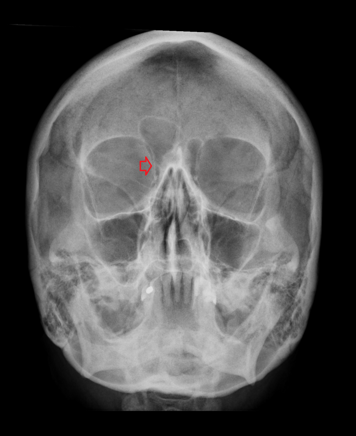 Medial wall of orbit x ray