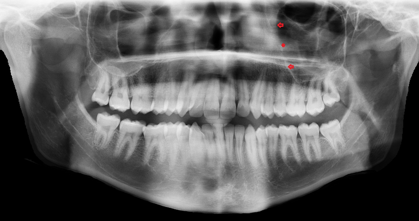 Medial wall of the maxillary sinus