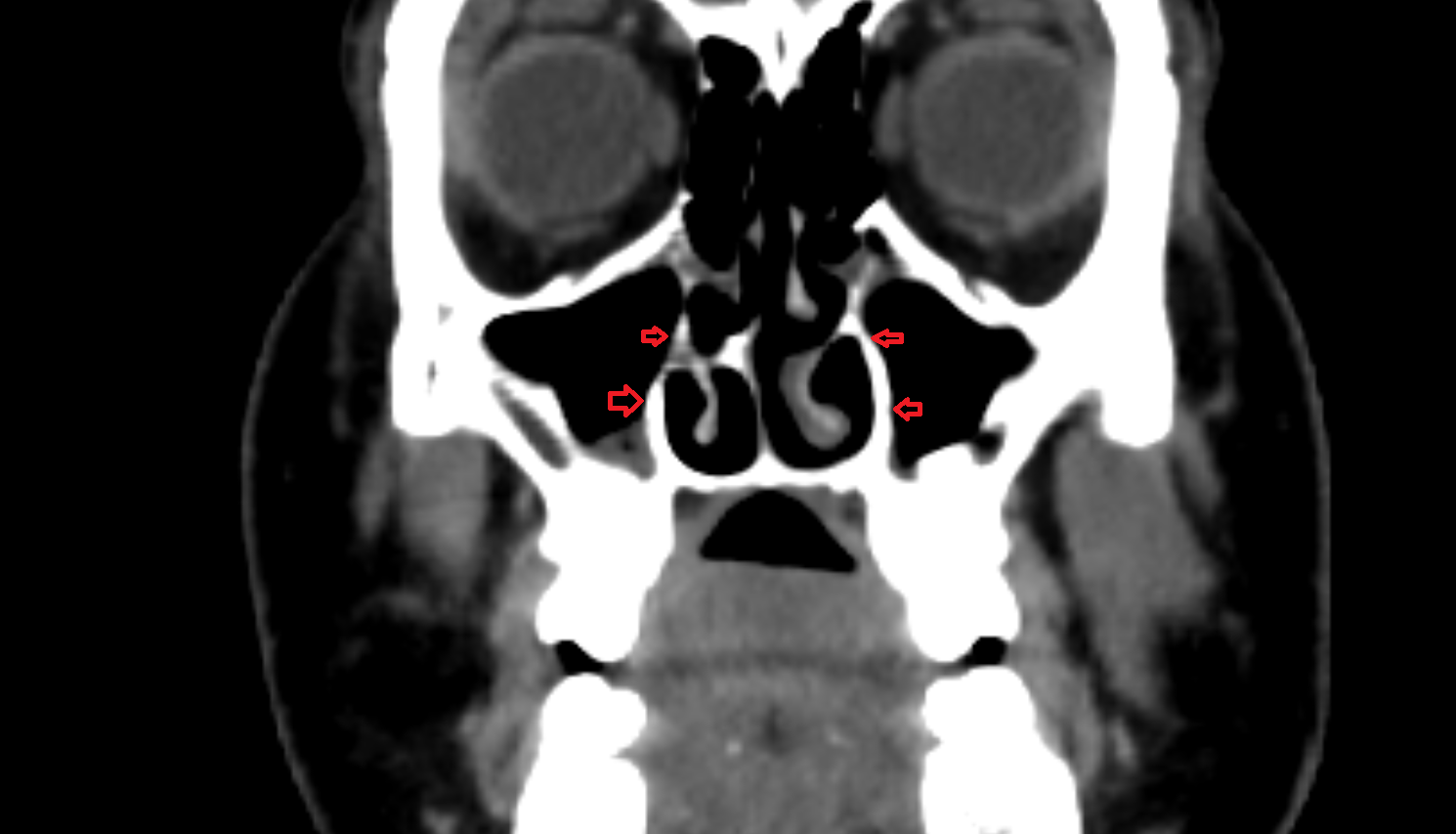 Medial wall of the maxillary sinus CT  anatomy labelled image-img-00000-00000
