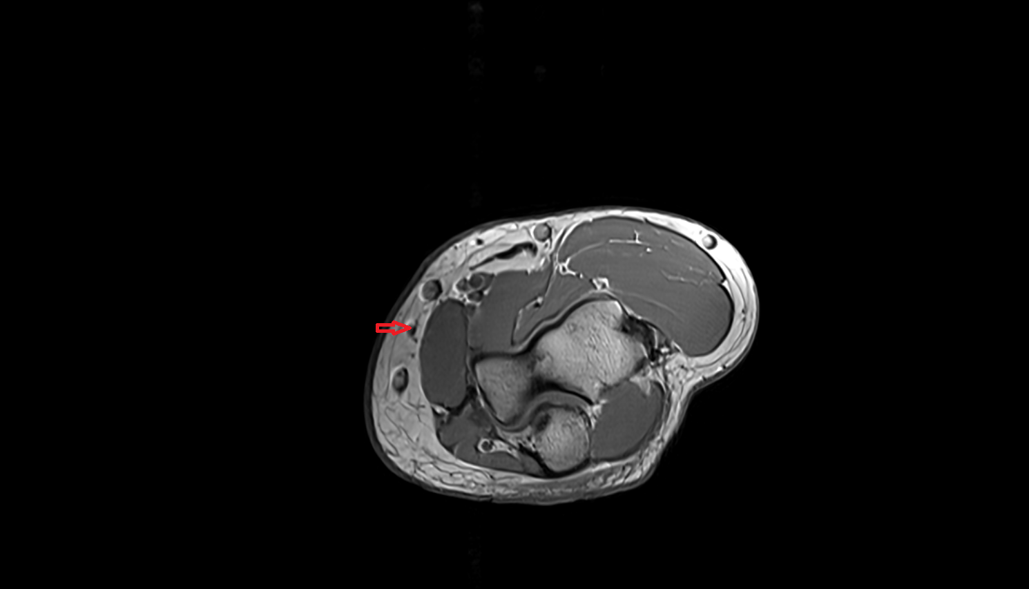 Median antebrachial vein axial cross sectional anatomy 3T MRI AI enhanced radiology image -img-00000-00000
