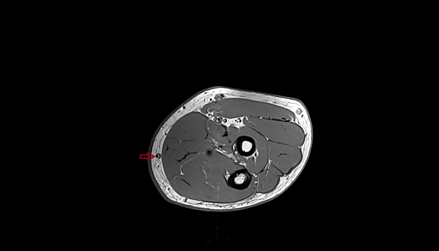 Median antebrachial vein axial cross sectional anatomy 3T MRI AI enhanced radiology image -img-00000-00000_00002