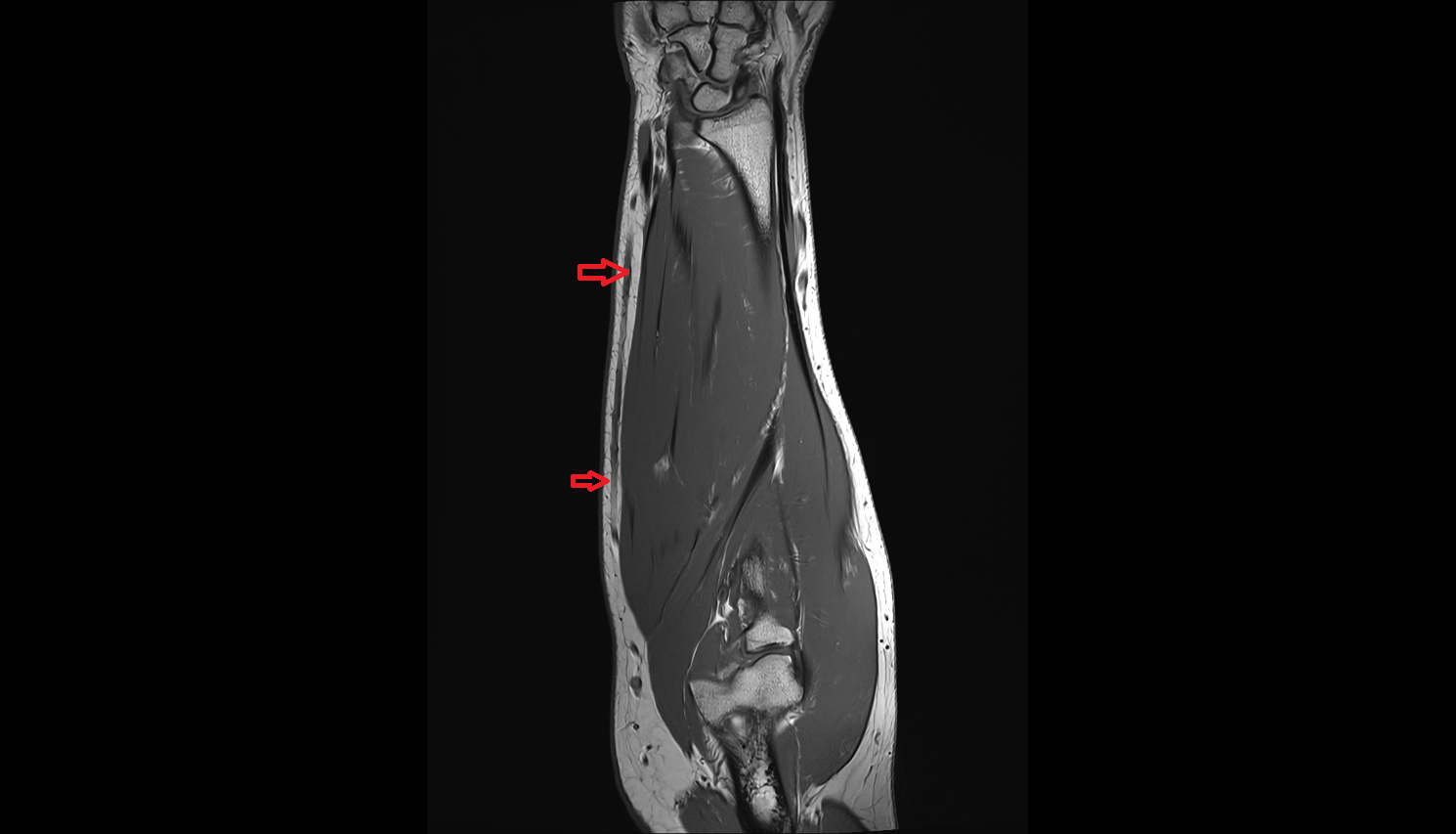 Median antebrachial vein coronal cross sectional anatomy 3T MRI AI enhanced radiology image -img-00000-00000
