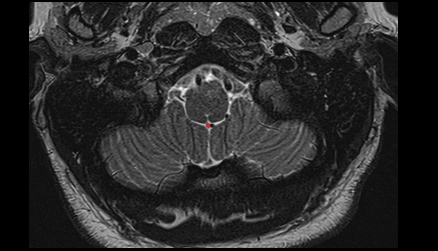 Median aperture of fourth ventricle (foramen of Magendie)