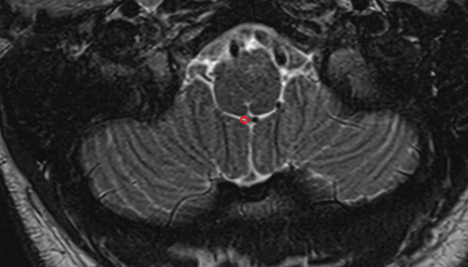 Median aperture of fourth ventricle (foramen of Magendie) mri axial  image -img-00000-00000