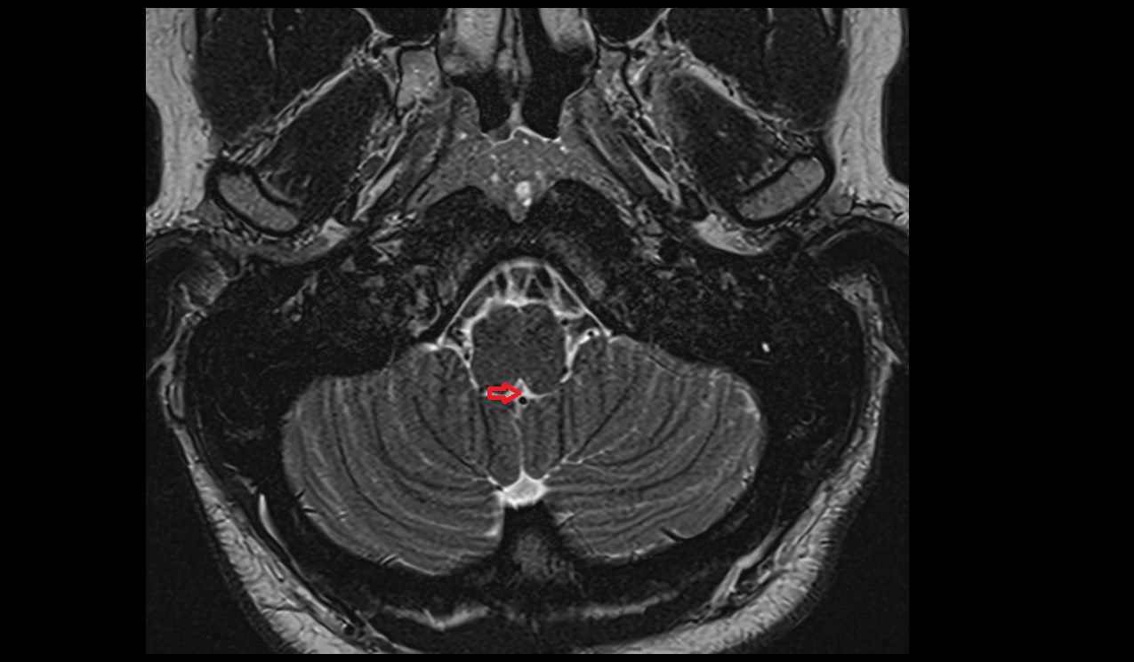 Median aperture of fourth ventricle mri 3t axial image